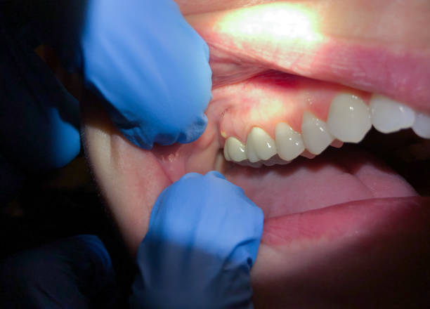Best Dentist for Tooth Abscess  in Luck, WI